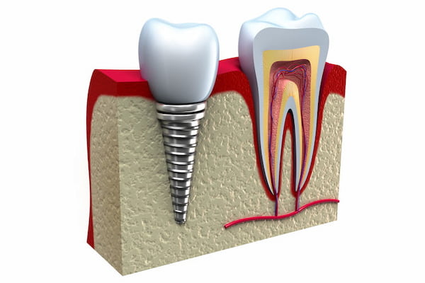 Impianti dentali Croazia