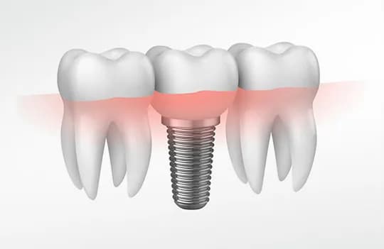 Impianti dentale